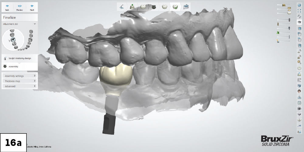 3D Oral Scan Showing Planned BruxZir Implant