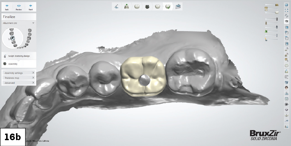 3D Oral Scan Showing Planned BruxZir Implant