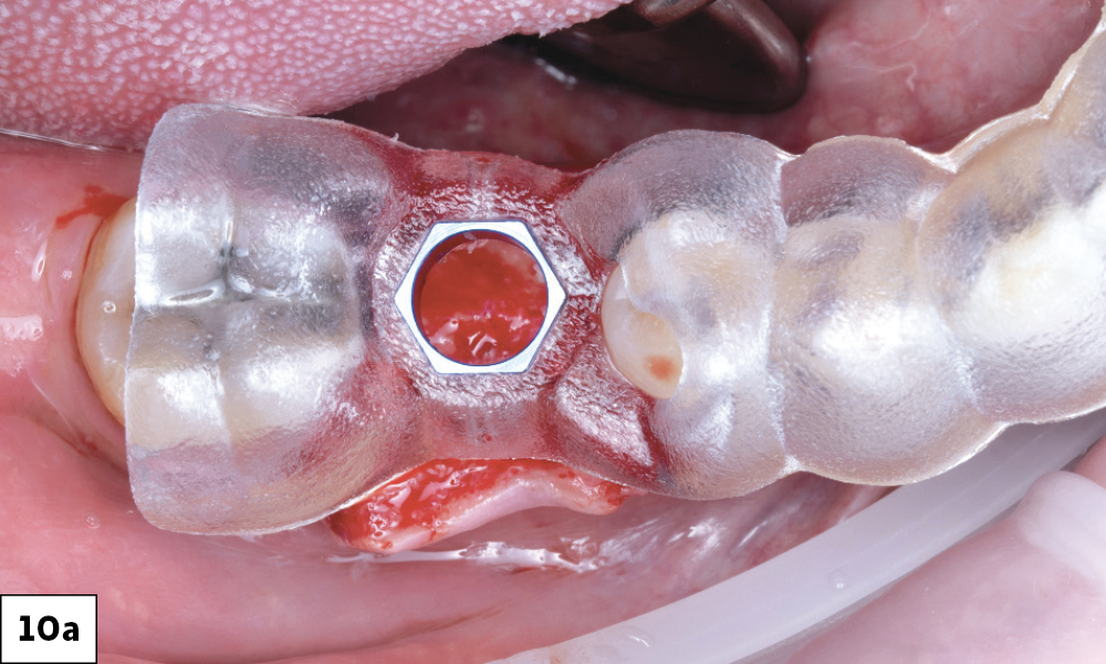 Ensuring the Tissue Flap's Non-Impedance of the Surgical Guide