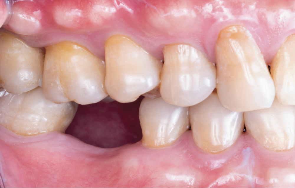Mesial-Distal Span and Interocclusal Distance