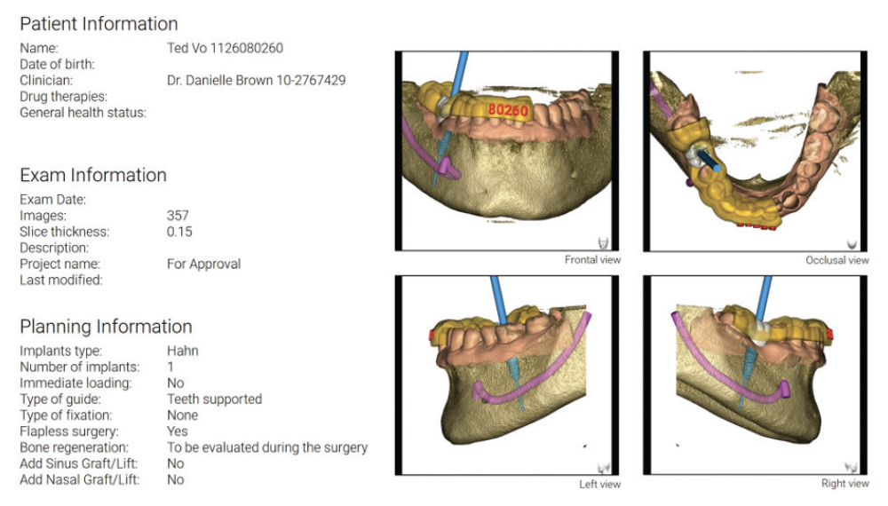 CBCT Scan and Schematics of Proposed Implant and Crown Placement