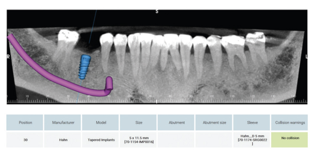 Mapping of the Interior Alveolar Nerve and the Metal Foramen
