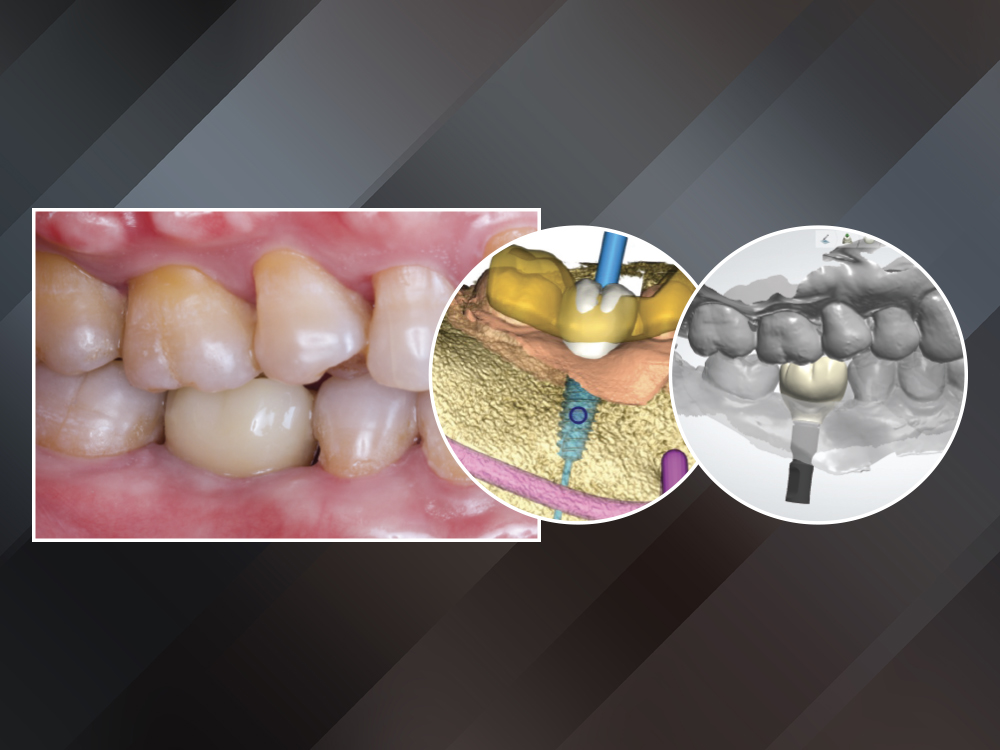 Digital Implant Workflow:  From Surgical Plan to Final Crown