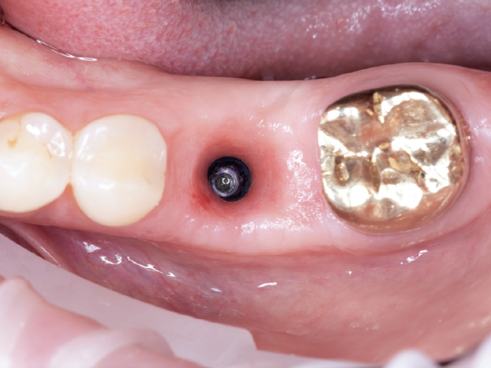 Verify the Emergence Profile