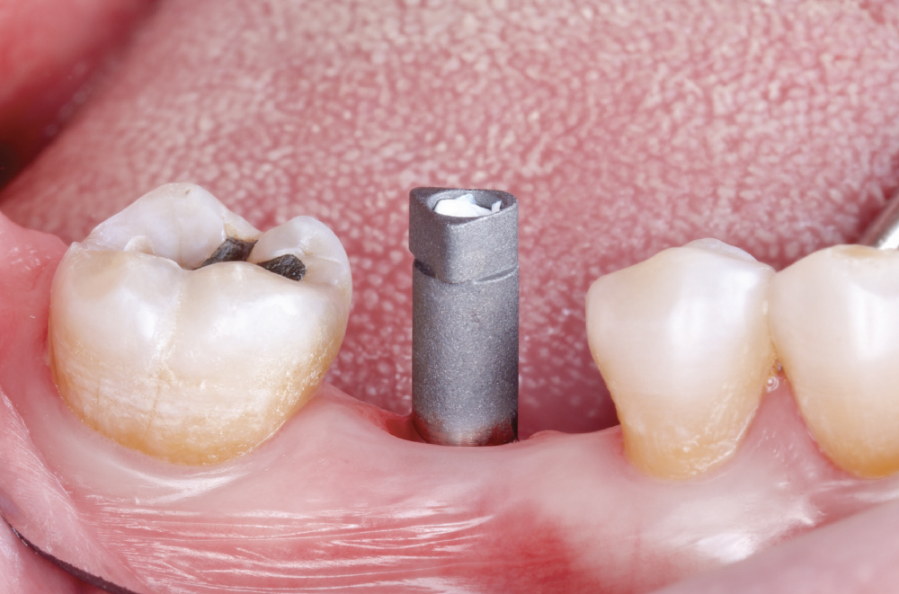 Implant post in socket