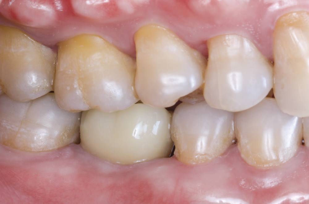 Finished Implant Restoration