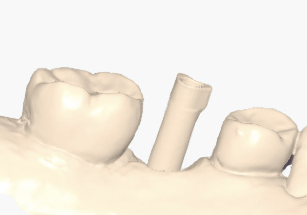 Implant post scan close up