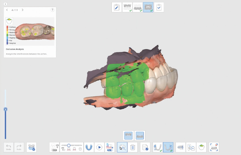 Capture interocclusal registration without the Scan Body
