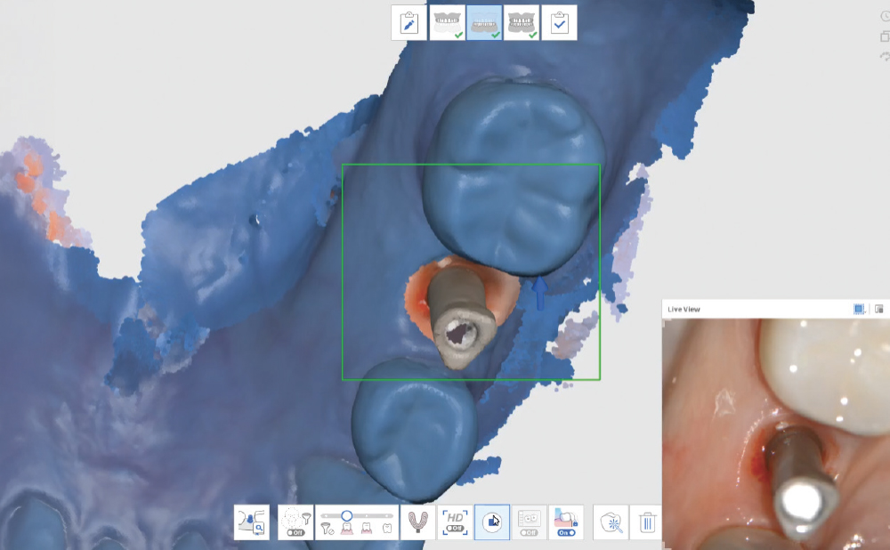 Thoroughly Scan the Scan Body Geometry