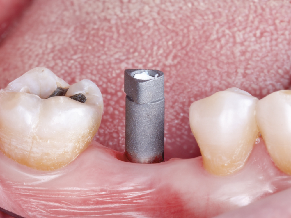 Do’s and Don’ts of Intraoral Scanning for Implant Restorations