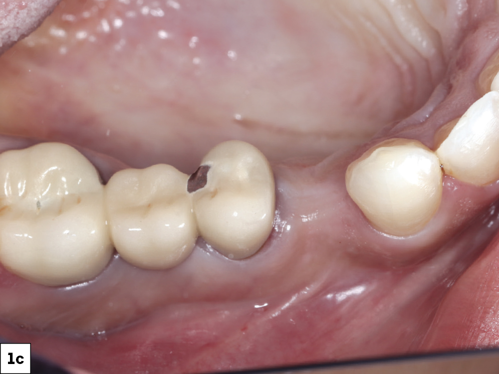 She had no medical contraindications and expressed a strong desire for a rapid restoration of her smile