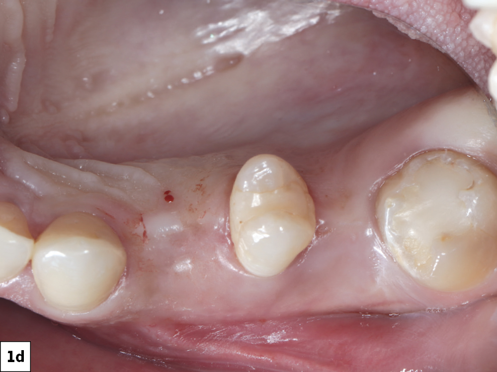 Both sides had healed from previous extractions. Site #5 exhibited sufficient bone width and height for immediate implant placement