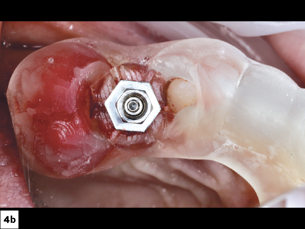 Two Glidewell HT™ Implants (Glidewell Direct; Irvine, Calif.) were placed according to the digital plan, achieving excellent primary stability-b