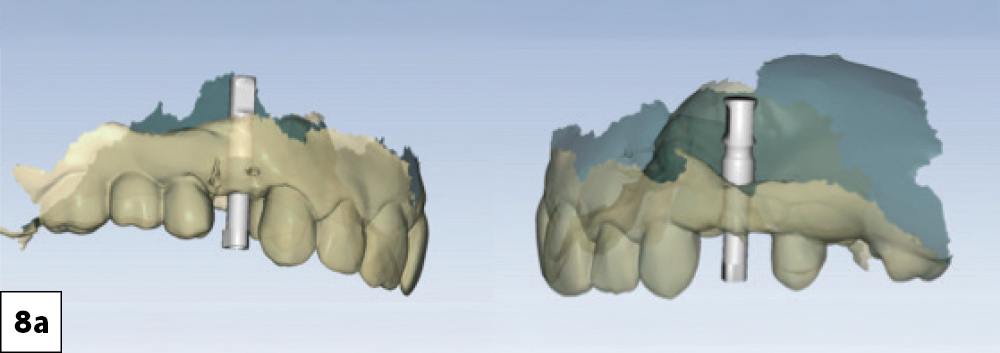 The fastdesign.io software automatically recognized the implant platforms and the geometry of the BruxZir® NOW SRC zirconia milling blocks prefabricated with attached titanium bases