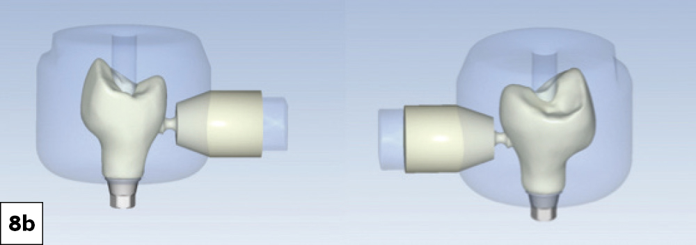This new milling block design represents a significant leap forward in chairside implant restoration