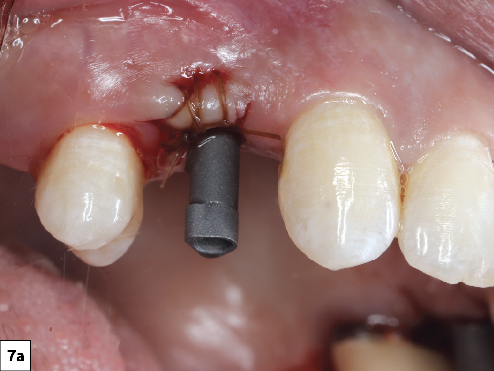 Allograft was placed to restore the buccal contour and covered with a collagen membrane to stabilize the graft and support hard- and soft-tissue regeneration
