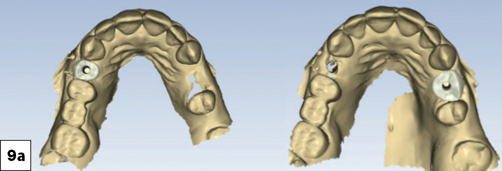 Two screwretained crowns were designed with precise occlusal morphology and customized emergence profiles to support the peri-implant soft tissue-a