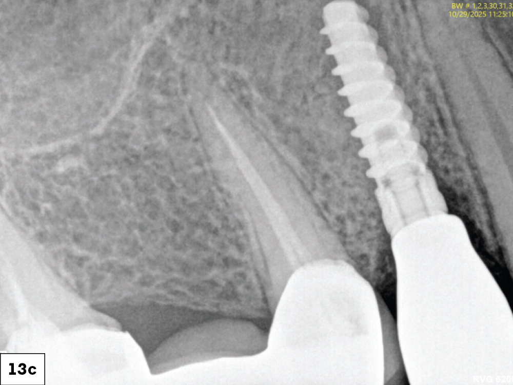 At eight weeks, mature keratinized mucosa framed the zirconia crowns with stable crestal bone levels and ideal emergence profiles were confirmed radiographically-c