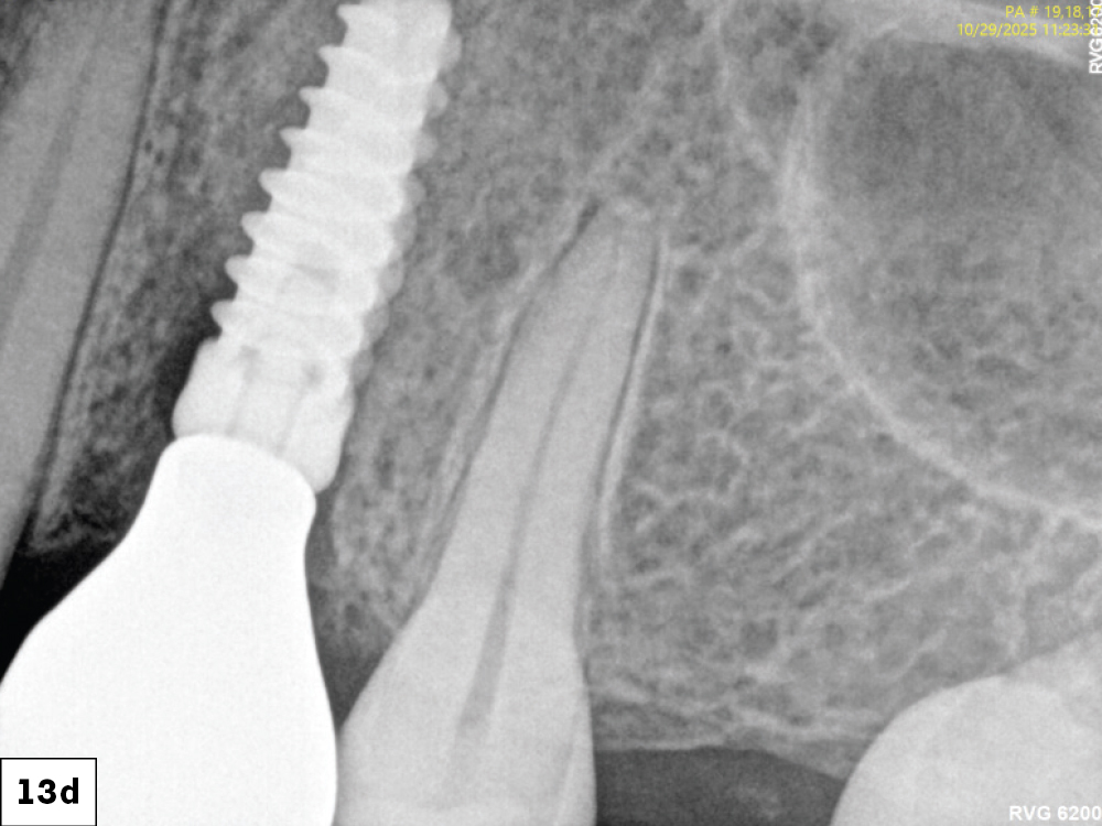 At eight weeks, mature keratinized mucosa framed the zirconia crowns with stable crestal bone levels and ideal emergence profiles were confirmed radiographically-d
