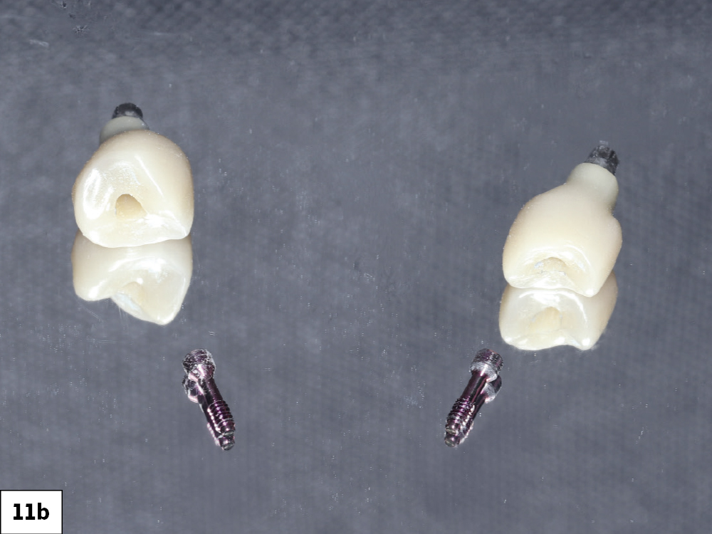 Because the zirconia is fully sintered, no oven firing, sintering, or glazing cycle was required