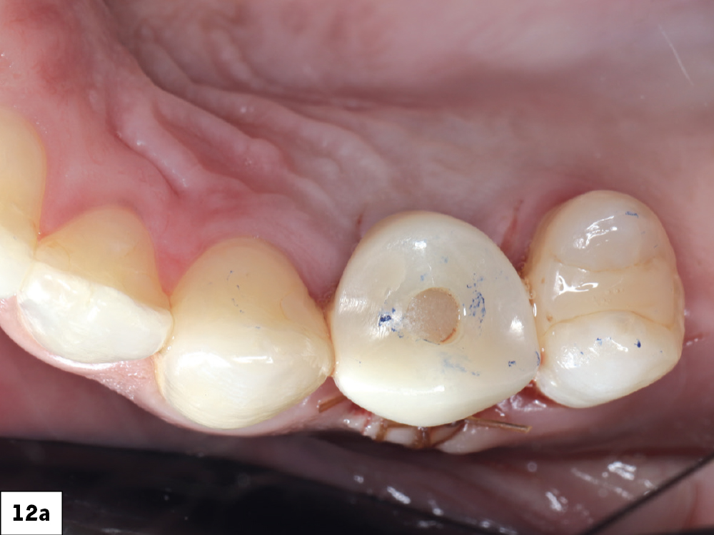 Occlusal contacts required only minor adjustments