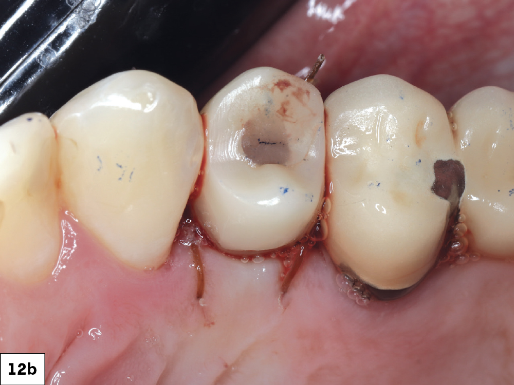 Each screw-retained crown was seated onto the corresponding Glidewell HT Implant, torqued to the manufacturer’s specifications, and sealed with PTFE tape and composite resin