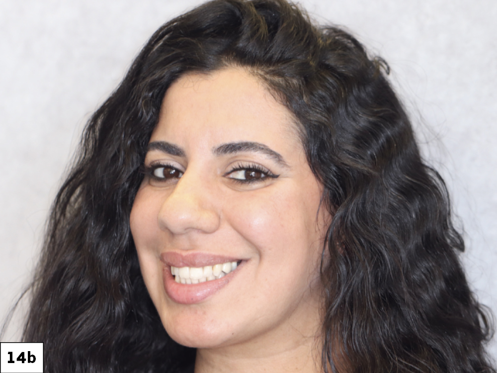 She entered the office that morning missing two premolars and left a few hours later with final, monolithic zirconia restorations that were both functional and esthetically pleasing