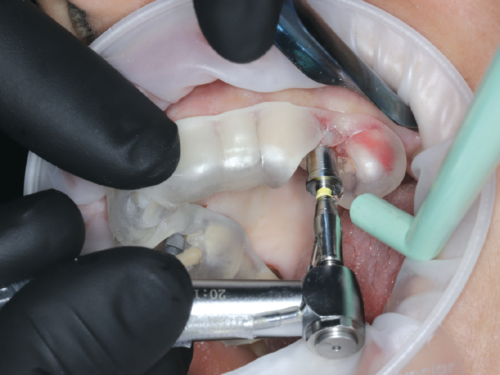 Once verified, a fully guided sleeveless surgical guide was digitally returned to the practice allowing in-office printing without the need for gluing in metal sleeves