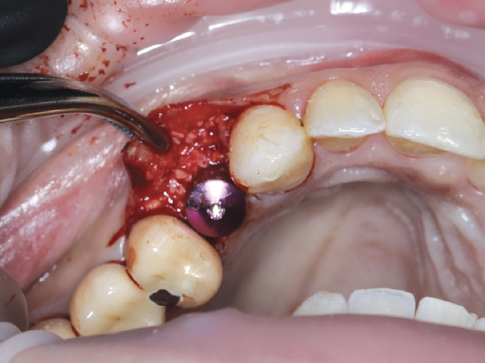 At site #12, the buccal plate was found to be thin and deficient, necessitating simultaneous grafting