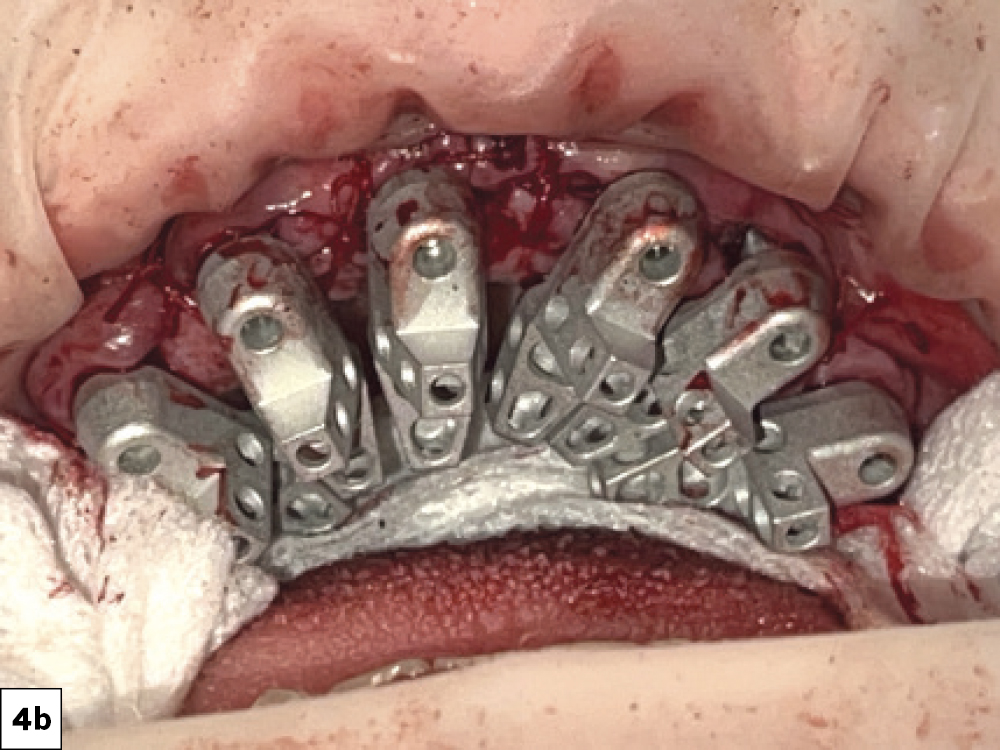 Aligned Wing-Like Projections