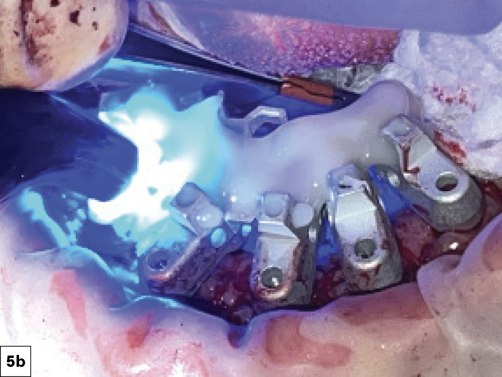 OptiSplint Attached to Scan Bodies