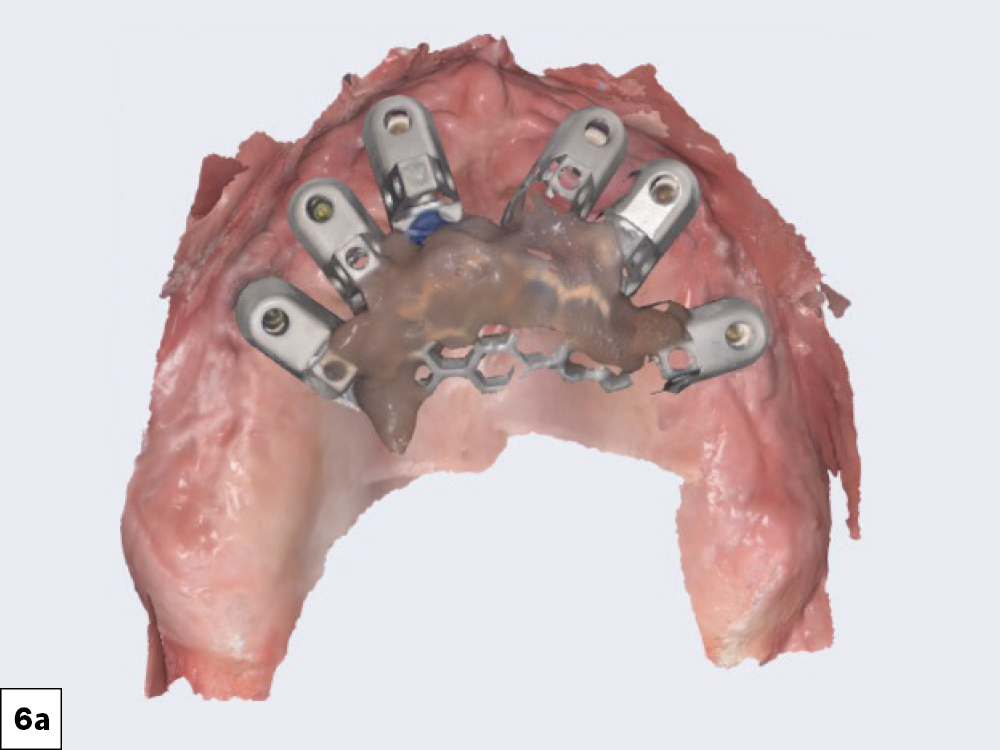Capturing Implant Position