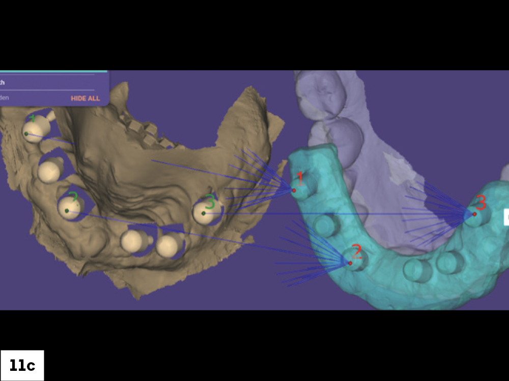 Setting Correct Vertical Dimension