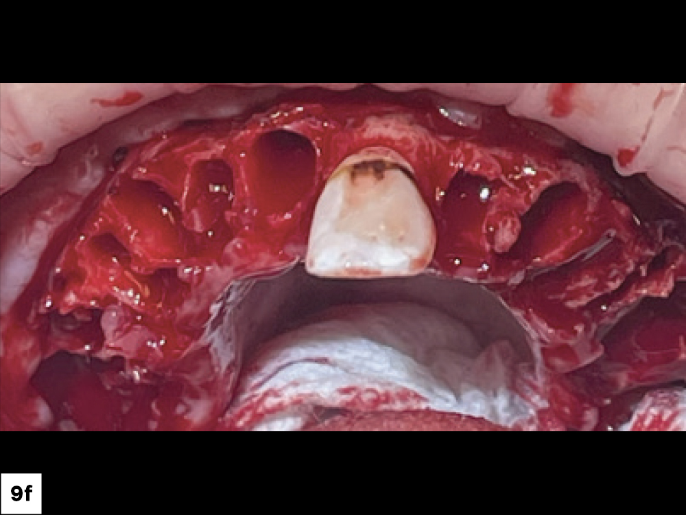 Fiducial Marker Tooth