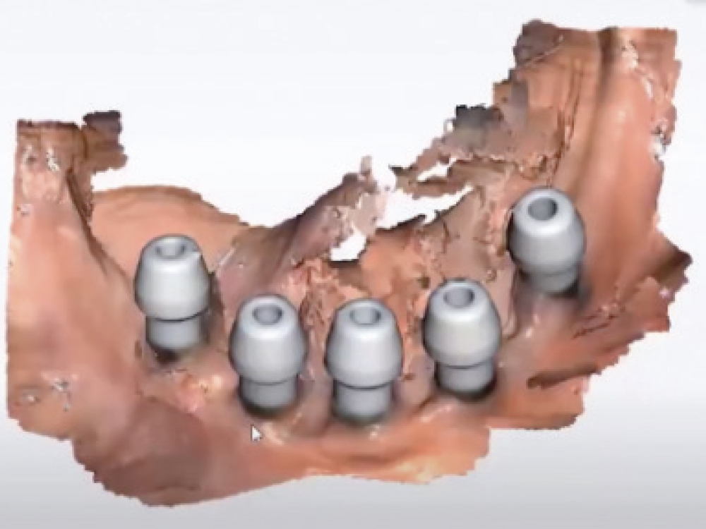 Scannable Healing Caps Inserted