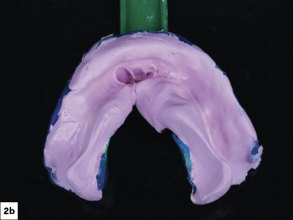  Initial physical impressions were made for the purpose of fabricating bite blocks used in the immediate denture phase.