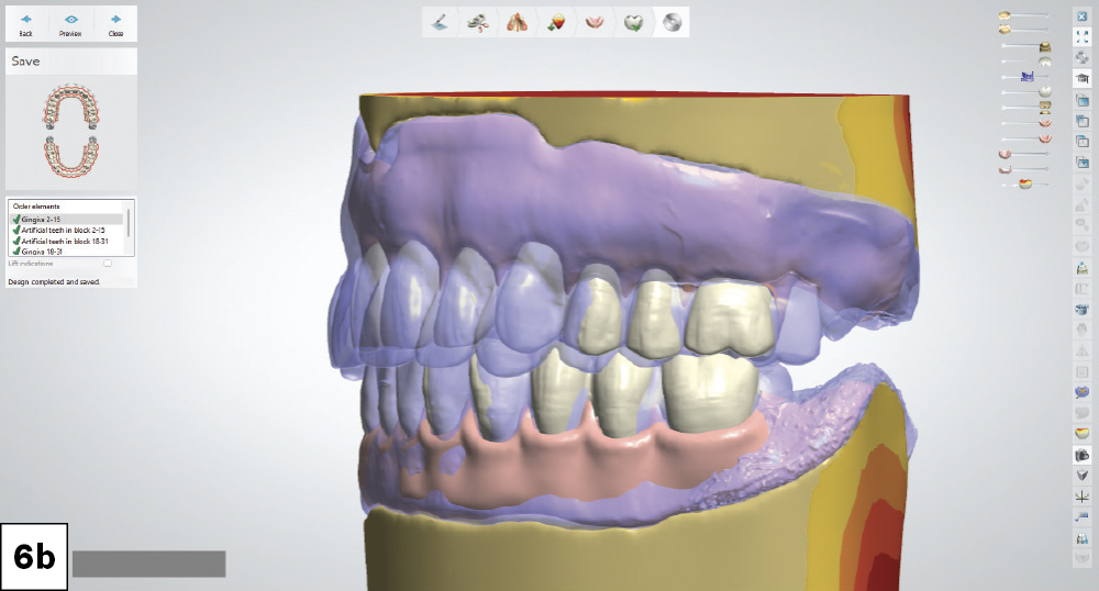Digital design modifications were performed on both the maxillary and mandibular dentures