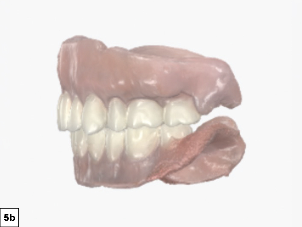 Then, the dentures were placed back into the mouth to capture the bite intraorally.
