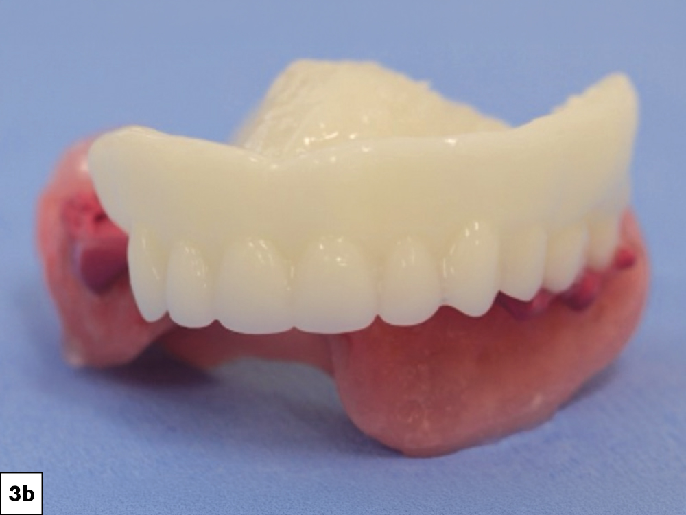 The custom bite blocks helped determine the proper vertical dimension of occlusion and centric relation position prior to immediate denture fabrication.