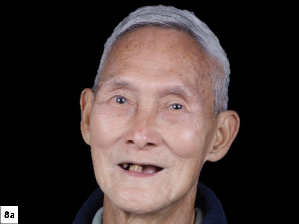 The patient was thrilled with the result, achieving  restored function, confidence, and a natural-appearing smile.