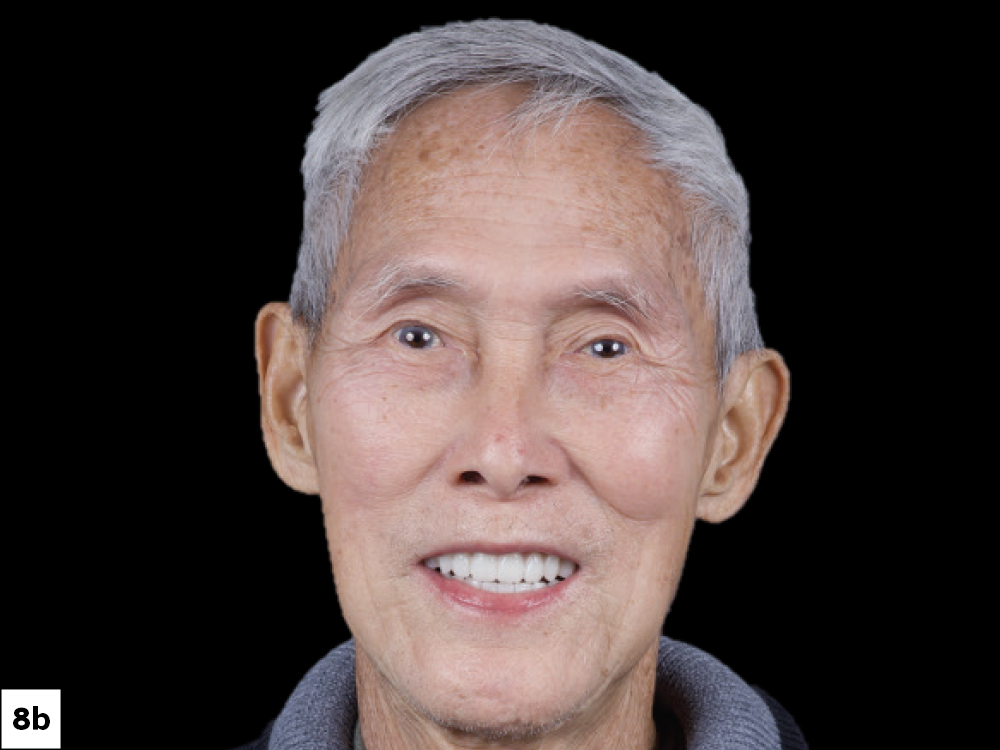 The patient was thrilled with the result, achieving  restored function, confidence, and a natural-appearing smile.