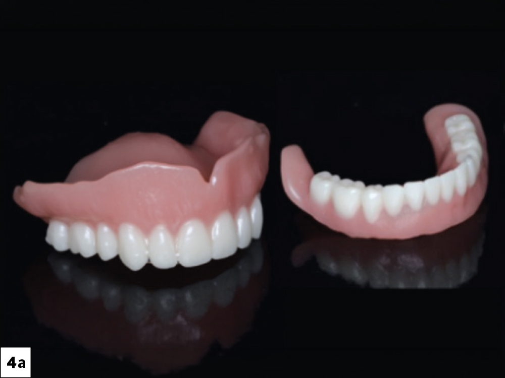 3D-printed immediate dentures were ordered from the lab for delivery at the time of extraction, serving the purpose of maintaining function, aiding in healing, and providing a reference for definitive denture fabrication.