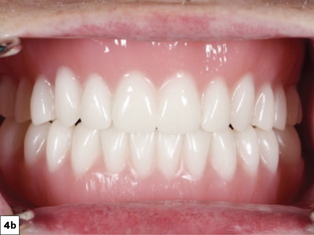 D-printed immediate dentures were ordered from the lab for delivery at the time of extraction, serving the purpose of maintaining function, aiding in healing, and providing a reference for definitive denture fabrication.