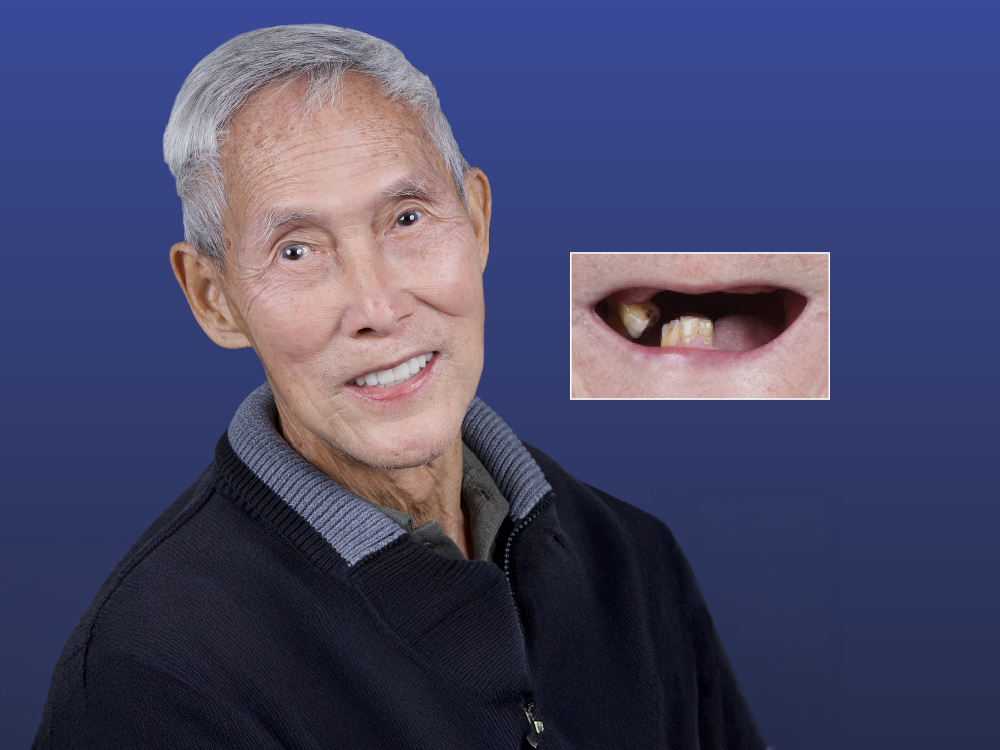 Two-Phase Digital Dentures: Immediate to Definitive with a 3D-Printed Workflow