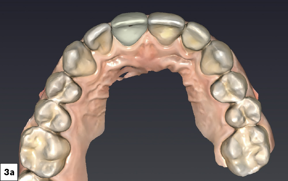 I utilized the fastdesign.io mirror function to create restorative designs that establish symmetrical contours between teeth #8 and #9 as well as for #24 and #25. I also verified proximal contacts and occlusion prior to milling.
