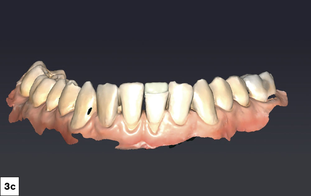 I utilized the fastdesign.io mirror function to create restorative designs that establish symmetrical contours between teeth #8 and #9 as well as for #24 and #25. I also verified proximal contacts and occlusion prior to milling.