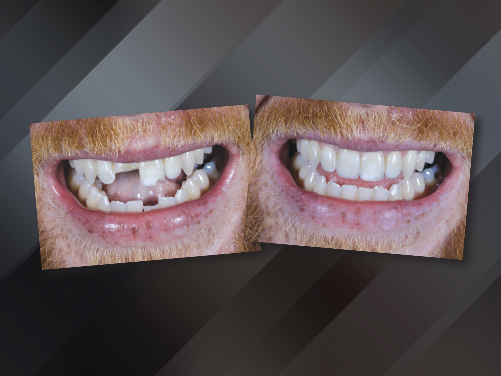 Same-Day, Multiple Restorations