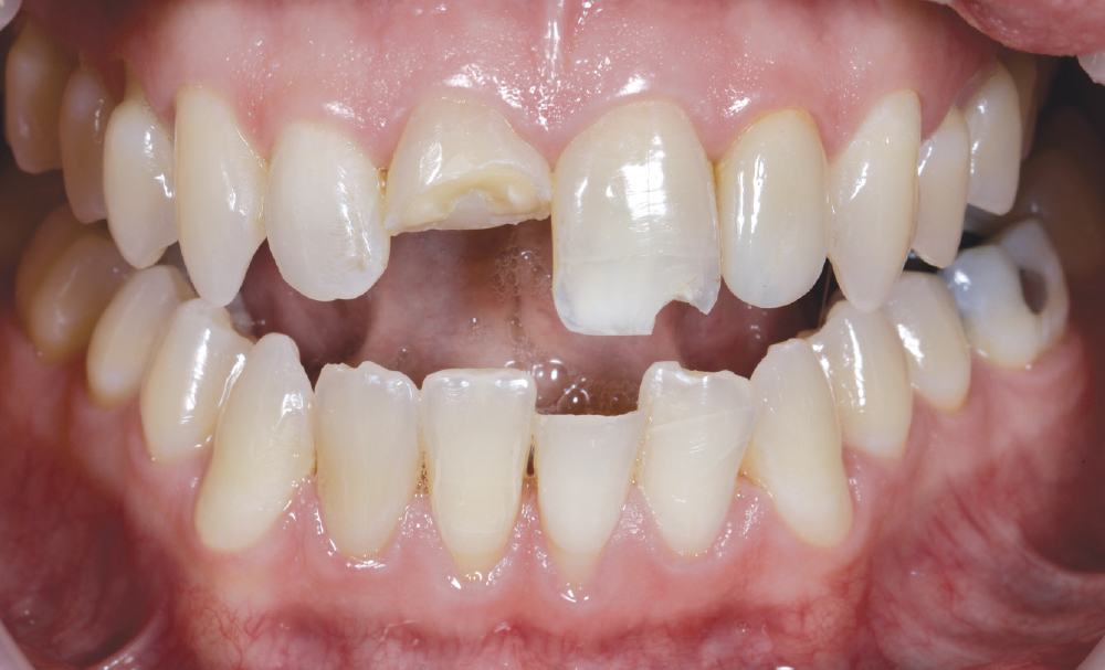 he initial consultation determined that tooth #8 exhibited a horizontal crown fracture involving approximately 50% of the clinical crown. Tooth #9 demonstrated a distoincisal fracture with rounded enamel-dentin involvement and loss of incisal edge continu