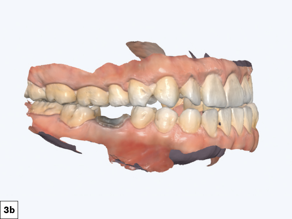 he intraoral scan and CBCT are required records for the DTP team who received the digital files along with the request for an immediate guided implant placement treatment plan.