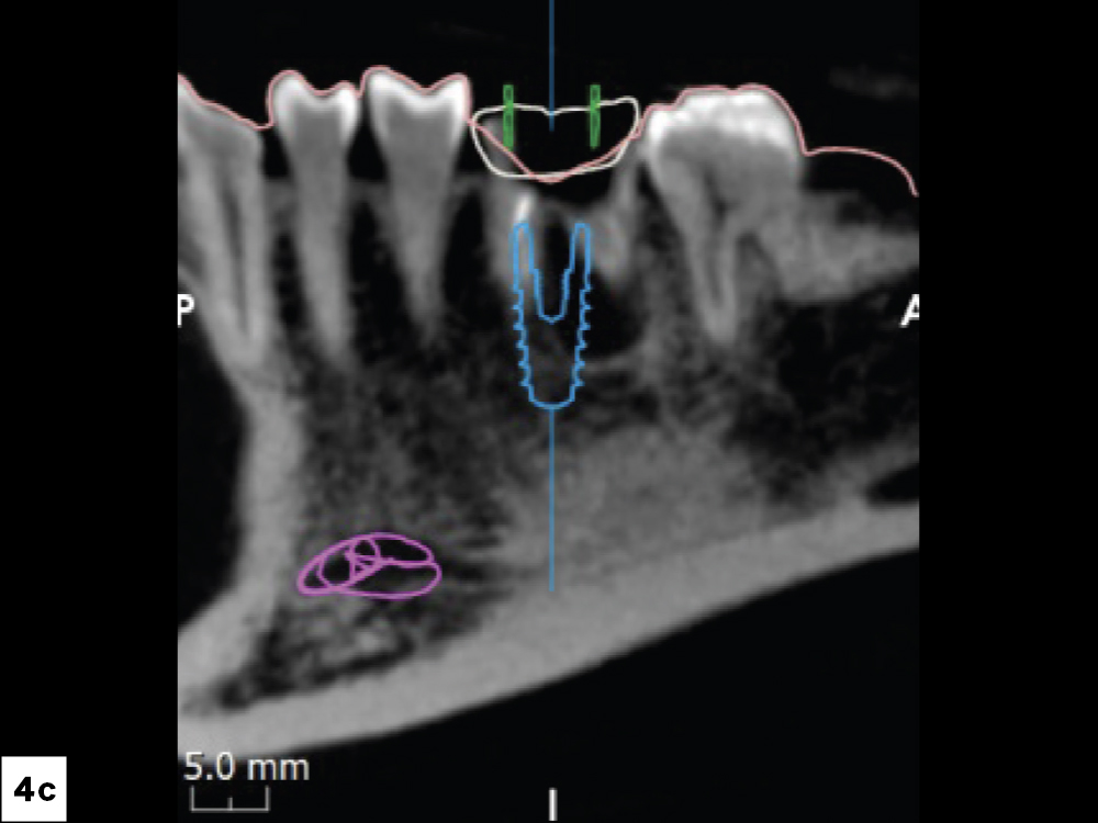 The approved digital treatment plan indicated exact implant location and confirmed there was adequate bone to place a  5 × 11.5 mm Glidewell HT™ Implant 